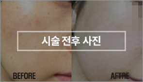 시술전후